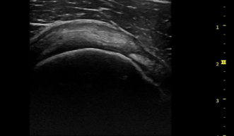 Supraspinatus Tendon